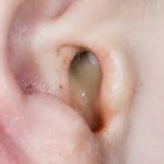 Cara Alami untuk Mengobati Infeksi Telinga