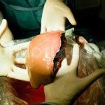 Risiko dan Bahaya Transplantasi Hati